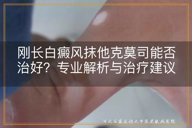 白癜风,他克莫司软膏,治疗,免疫抑制剂,生活习惯,防晒措施