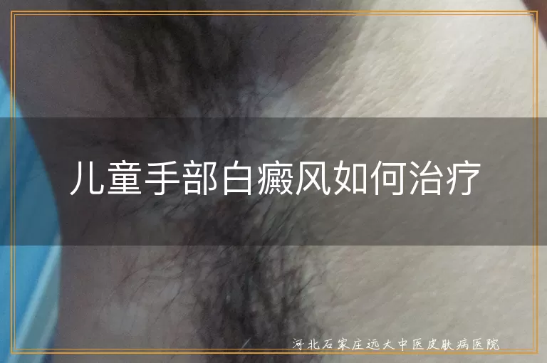 儿童白癜风,手部治疗,药物治疗,物理治疗,手术治疗,早期发现,正规医院,合理饮食,避免暴晒