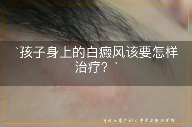 孩子身上的白癜风该要怎样治疗？