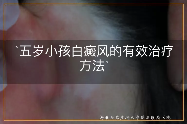 五岁小孩白癜风的有效治疗方法