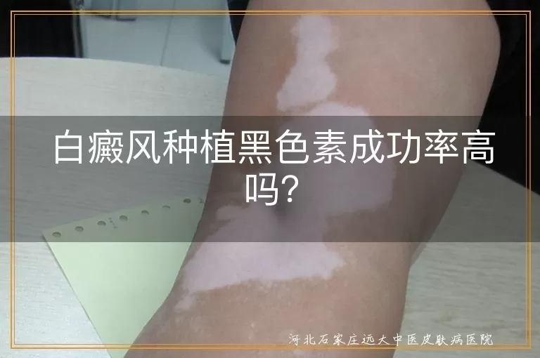 白癜风,黑色素种植,成功率,术后护理,个体差异