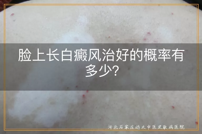 白癜风,治愈概率,早期治疗,光疗,药物治疗,生活习惯,防晒保湿