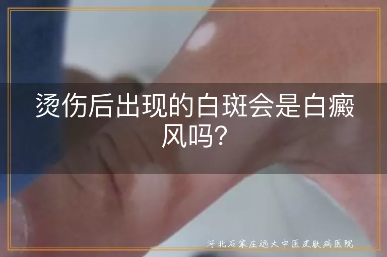 烫伤,白斑,白癜风,色素脱失,就医检查