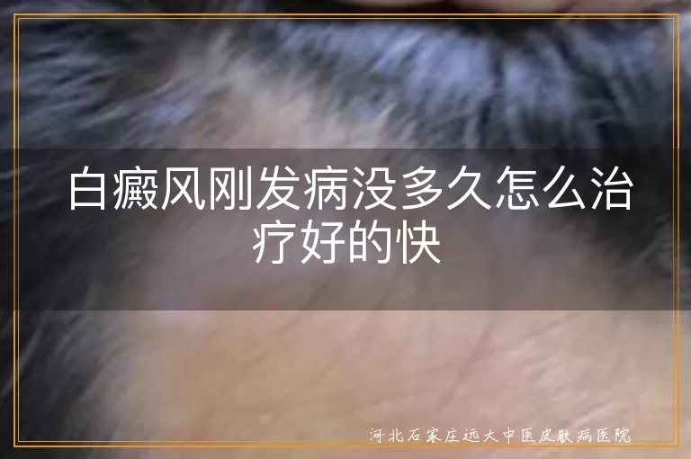 白癜风,早期治疗,综合治疗,内用药物,外用药物,物理治疗,生活调整,坚持治疗,定期复查