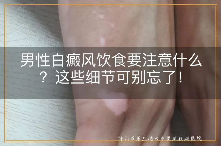 男性白癜风饮食要注意什么？这些细节可别忘了！
