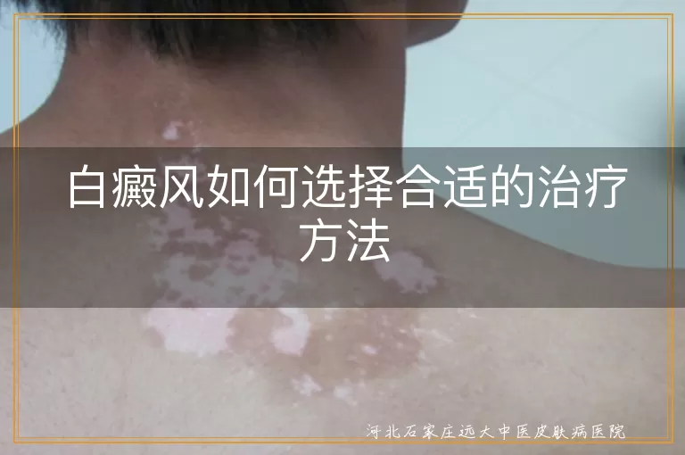 白癜风,治疗方法,药物治疗,光疗,激光治疗,手术治疗,个性化治疗,与医生沟通