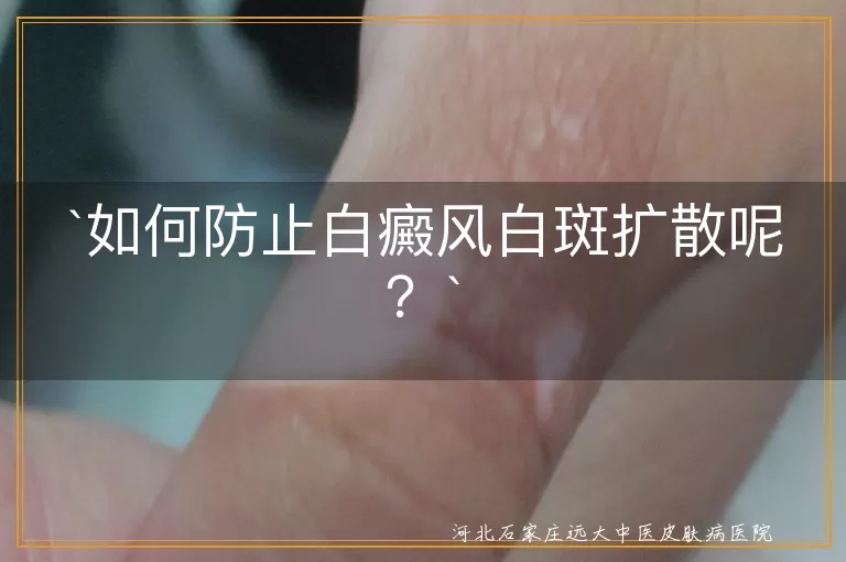 如何防止白癜风白斑扩散呢？