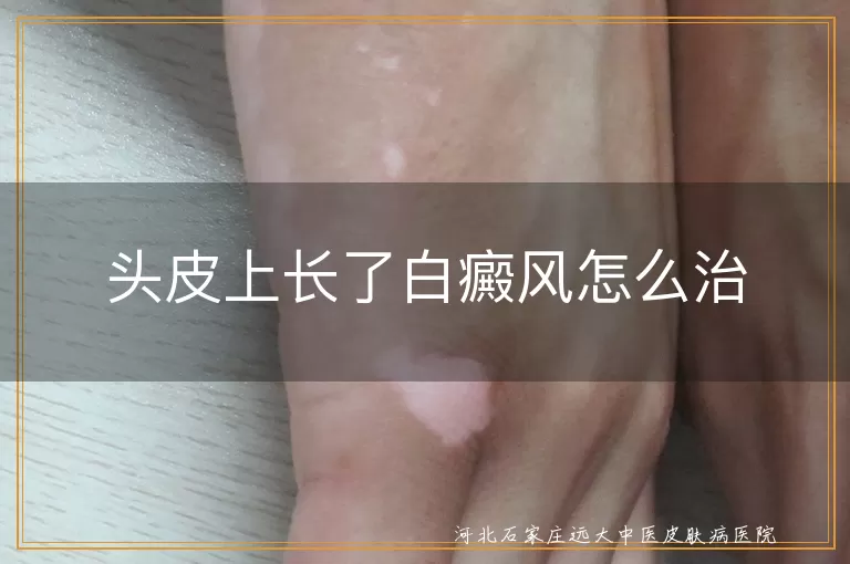 头皮白癜风,治疗方法,饮食调整,日常调理,心理治疗,药物治疗,光疗,手术治疗