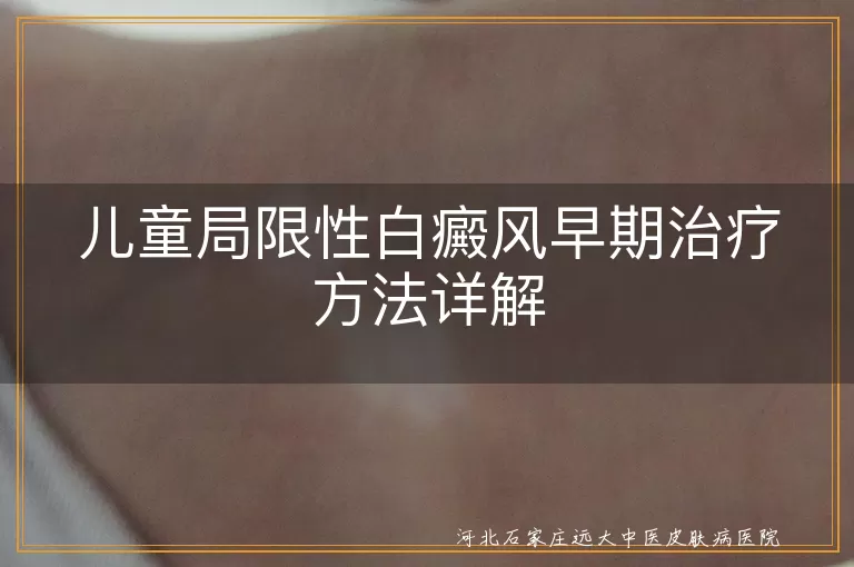 儿童局限性白癜风早期治疗方法详解
