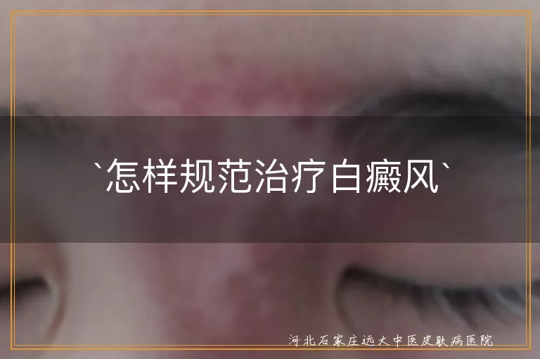 白癜风,规范治疗,个性化方案,综合治疗,日常护理,定期复查