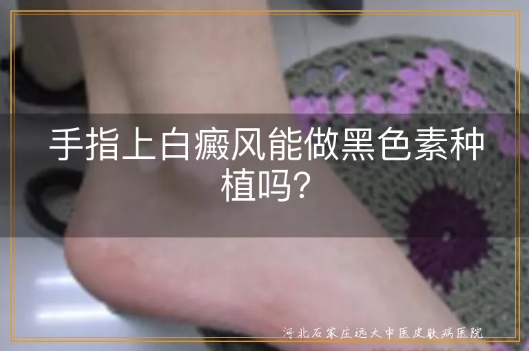 手指上白癜风能做黑色素种植吗？