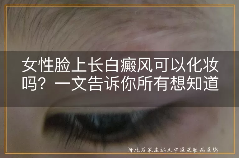 女性脸上长白癜风可以化妆吗？一文告诉你所有想知道的！