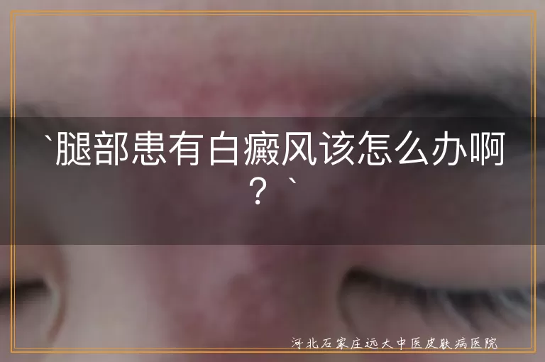 腿部患有白癜风该怎么办啊？