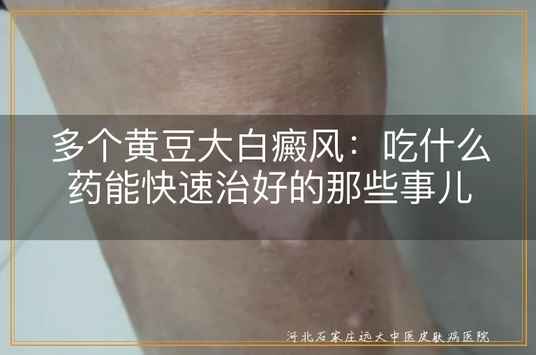 白癜风,黄豆大小,口服药,外用药,生活调理,防晒,饮食均衡,心态乐观