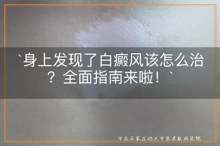 身上发现了白癜风该怎么治？全面指南来啦！