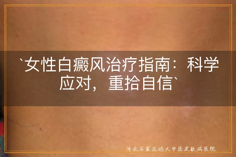 女性白癜风治疗指南：科学应对，重拾自信