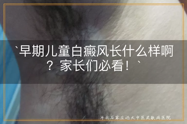 早期儿童白癜风长什么样啊？家长们必看！
