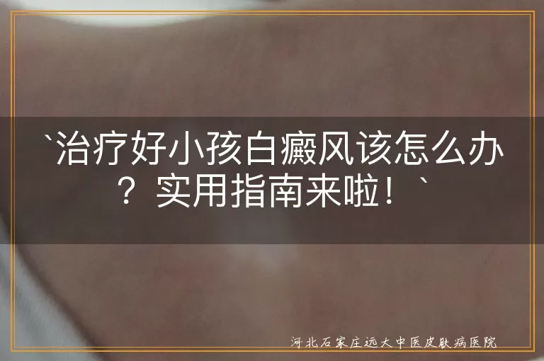 治疗好小孩白癜风该怎么办？实用指南来啦！