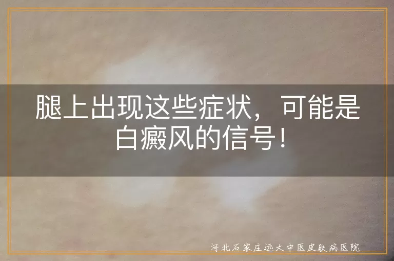 腿上出现这些症状，可能是白癜风的信号！