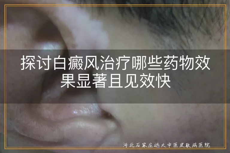 白癜风,治疗药物,见效快,综合性治疗,光疗,手术治疗,心理治疗,生活习惯