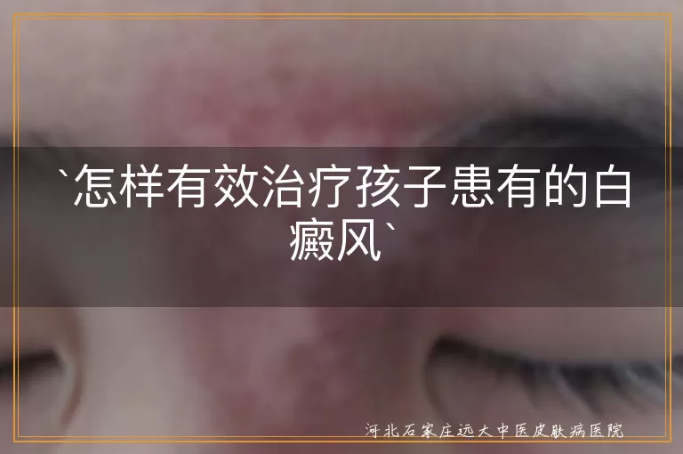 怎样有效治疗孩子患有的白癜风