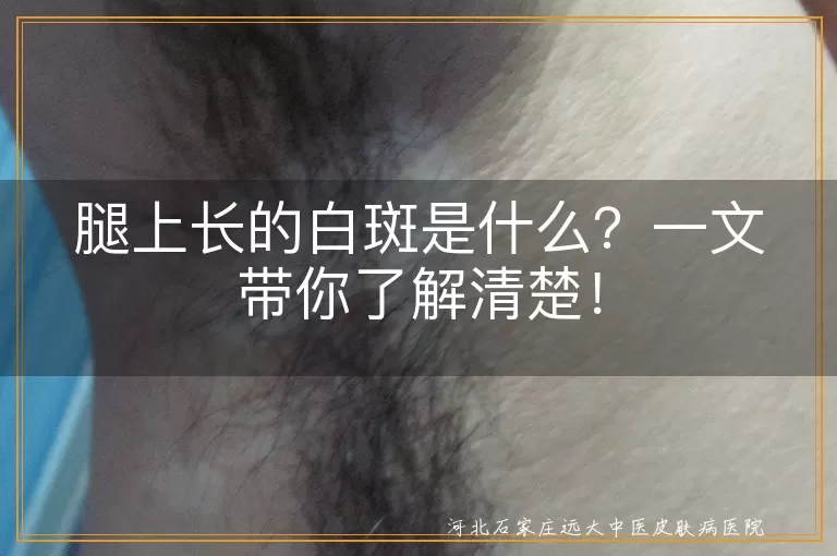 腿上白斑,白癜风,特发性点状白斑,花斑癣,贫血痣,皮肤病,伍德灯,对症治疗,生活习惯
