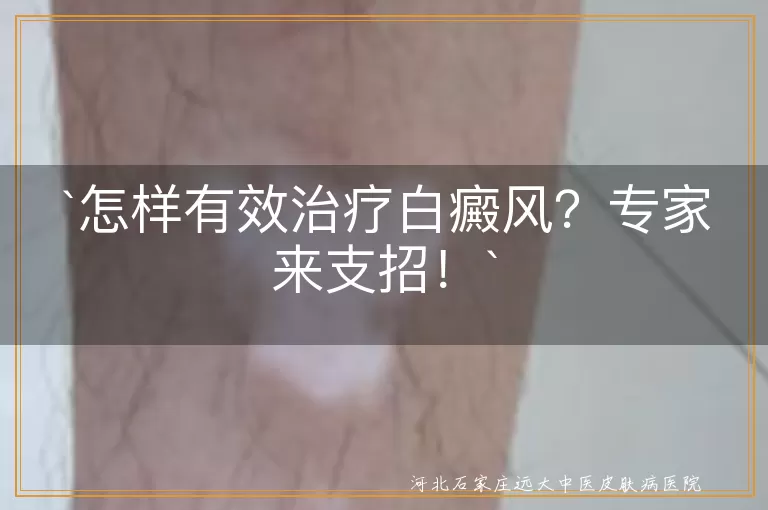 `白癜风,治疗原则,药物治疗,光疗,手术治疗,中医治疗,注意事项,专家建议`