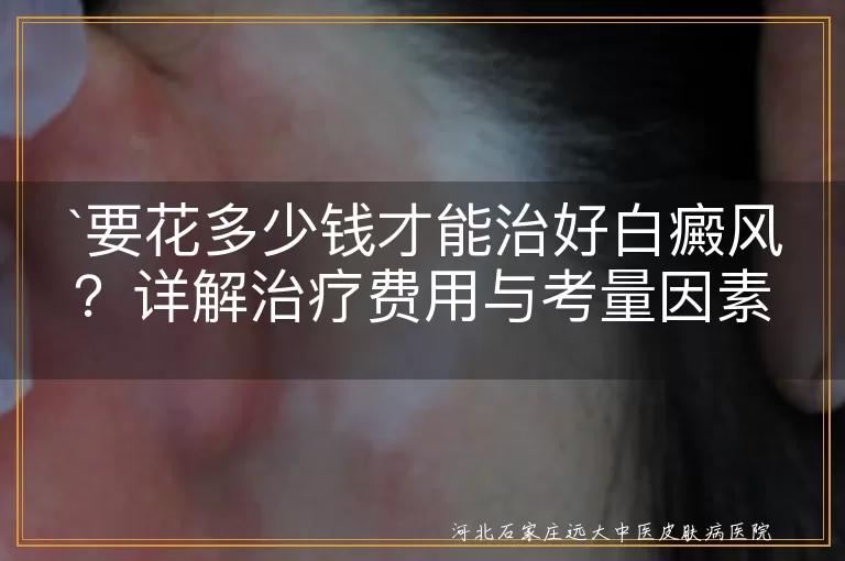 `白癜风,治疗费用,病情严重程度,治疗方法,治疗周期,所在地区,医院选择,医保政策`