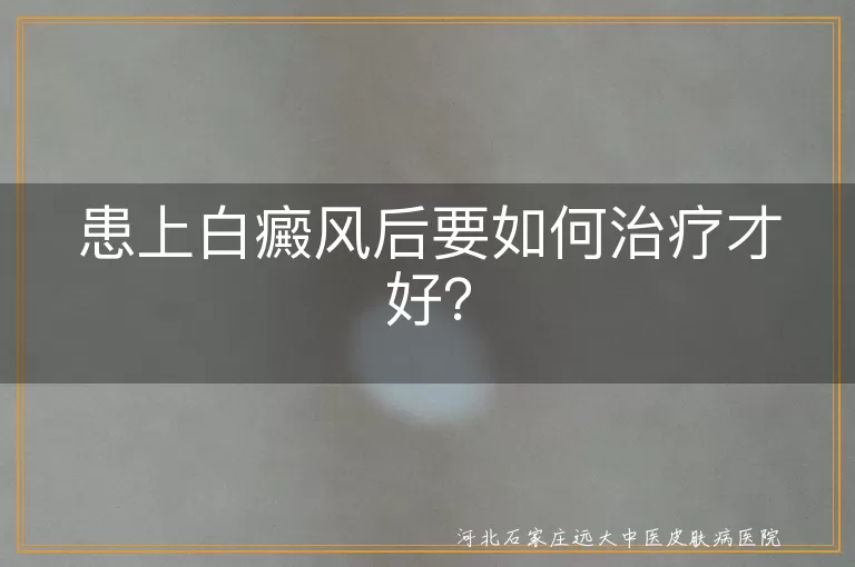 白癜风,治疗方法,专业医生,个性化方案,生活习惯,坚持治疗,定期复查