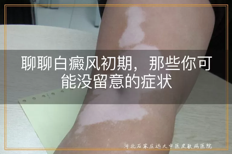 聊聊白癜风初期，那些你可能没留意的症状