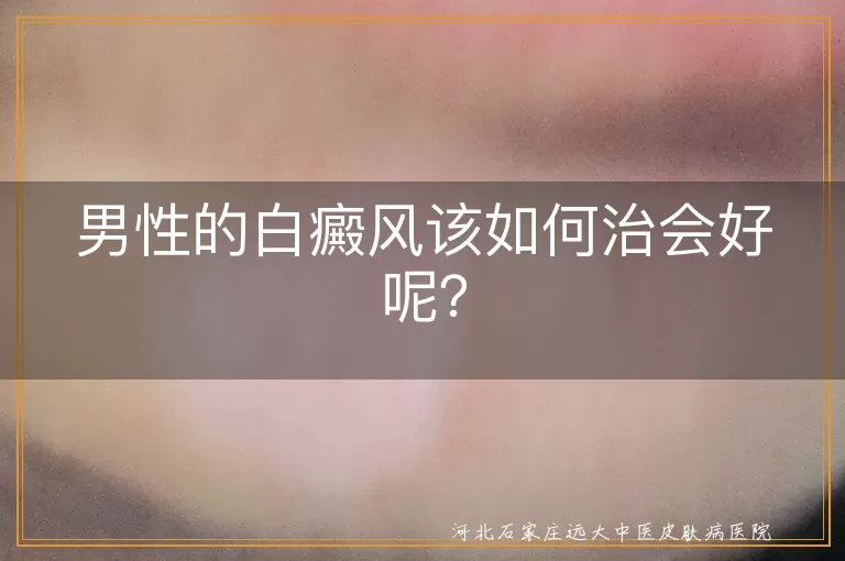 男性的白癜风该如何治会好呢？
