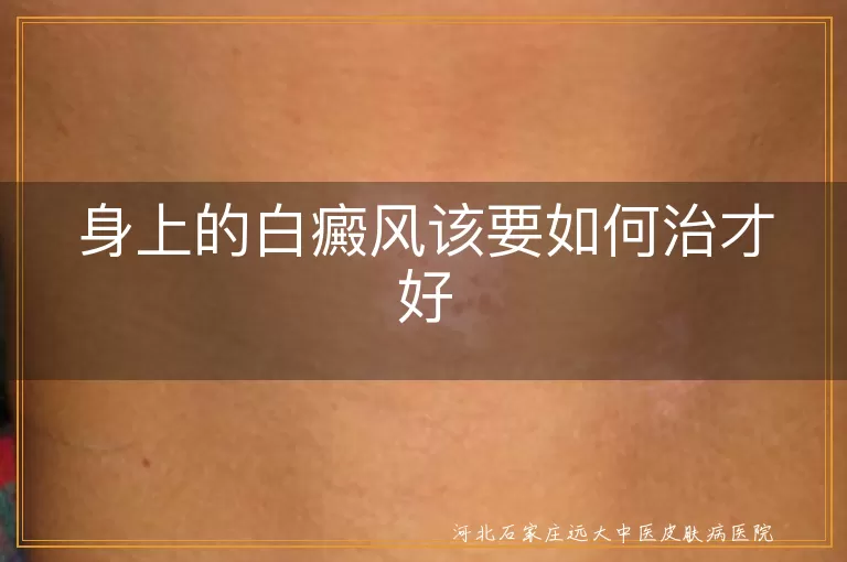 身上的白癜风该要如何治才好
