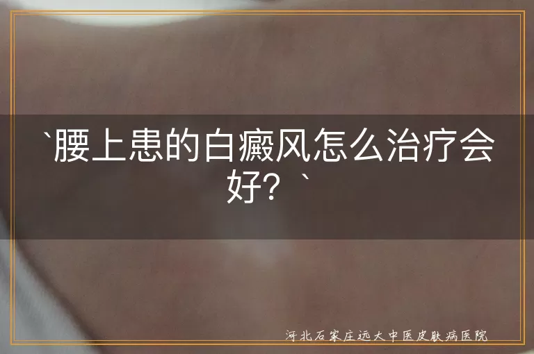 腰上白癜风,治疗原则,药物治疗,光疗,激光治疗,中医治疗,注意事项