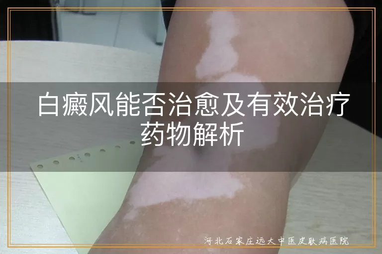 白癜风能否治愈及有效治疗药物解析