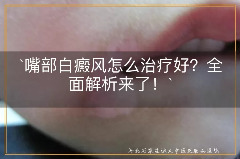 嘴部白癜风,治疗方法,药物治疗,光疗,激光治疗,手术治疗,生活调理