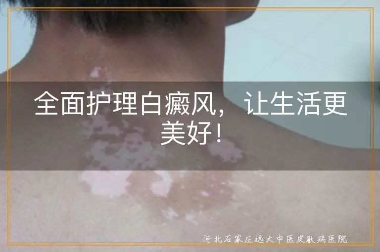 全面护理白癜风，让生活更美好！