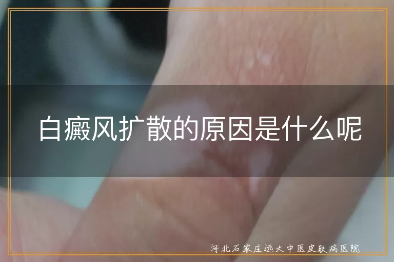 白癜风扩散的原因是什么呢