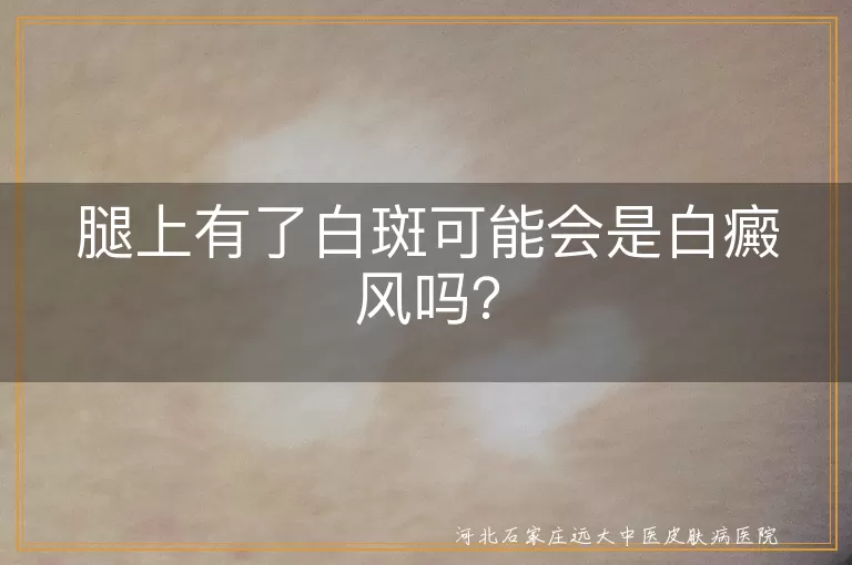 腿部白斑,白癜风,自身免疫性疾病,光疗,手术治疗,心理治疗
