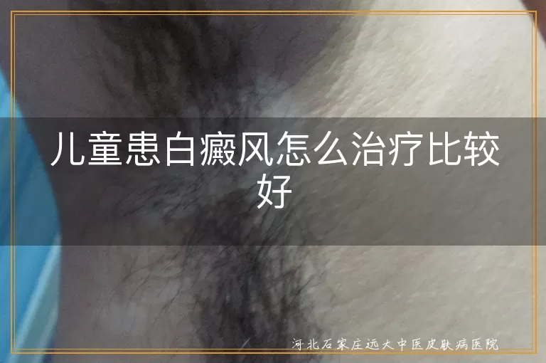 儿童白癜风,治疗方法,药物治疗,手术治疗,物理治疗,心理治疗,早发现早治疗