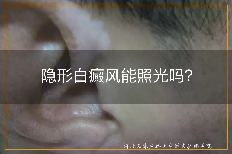 隐形白癜风能照光吗？