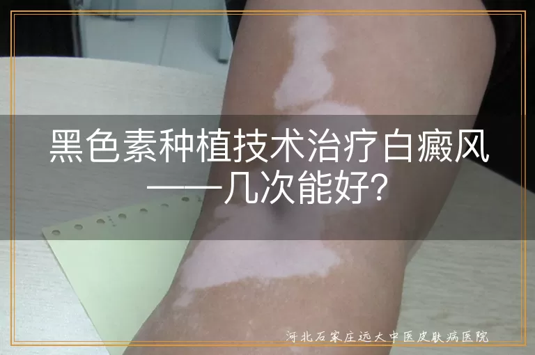黑色素种植技术治疗白癜风——几次能好？