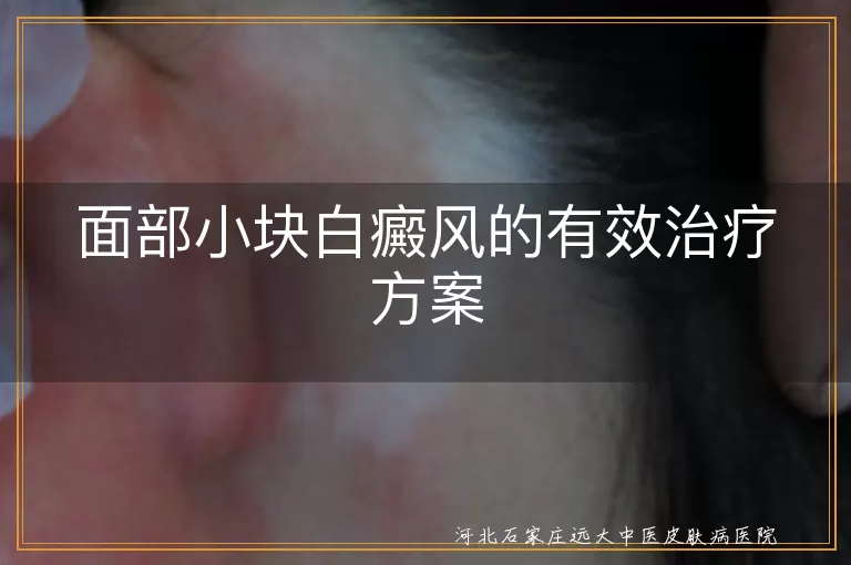 面部小块白癜风的有效治疗方案