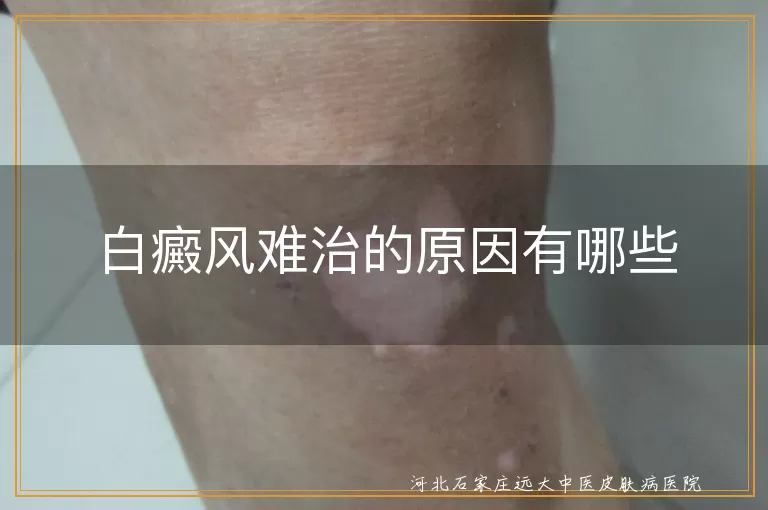 白癜风难治的原因有哪些