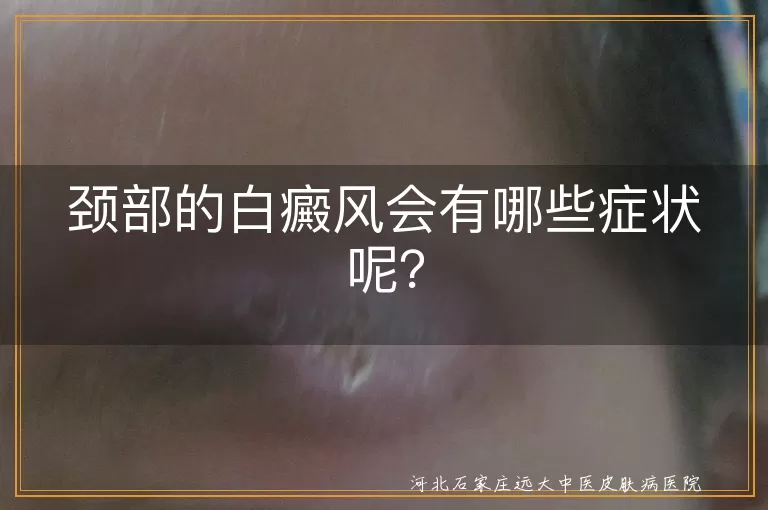 颈部白癜风,症状,白斑,皮肤感觉变化,白斑扩散,头发变白,识别,治疗,护理