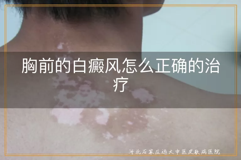 白癜风,胸前,治疗,专业医生,综合治疗,生活调理,定期复诊,心理支持
