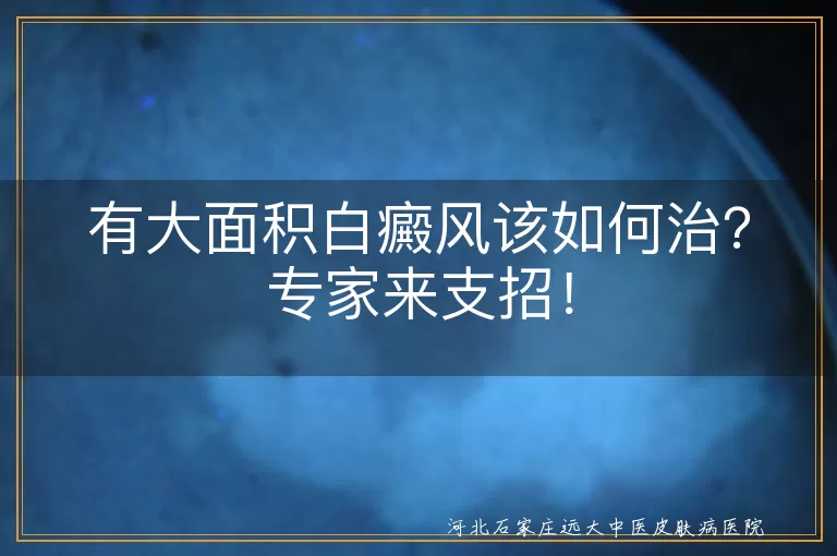 大面积白癜风,治疗,病因,综合治疗,护理,坚持,乐观心态