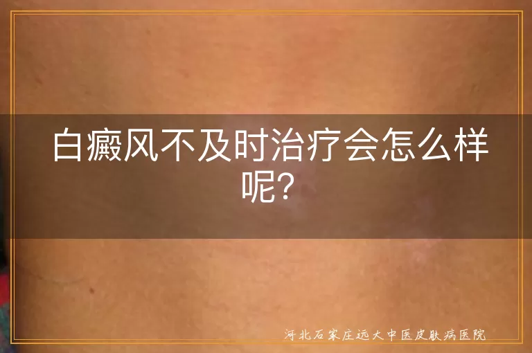 白癜风,不及时治疗,白斑扩散,心理压力,健康问题,治疗难度,生活品质下降