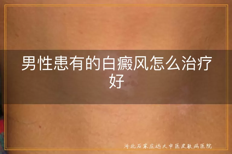 男性白癜风,治疗方法,一般治疗,药物治疗,光疗,手术治疗,心理治疗,中医治疗