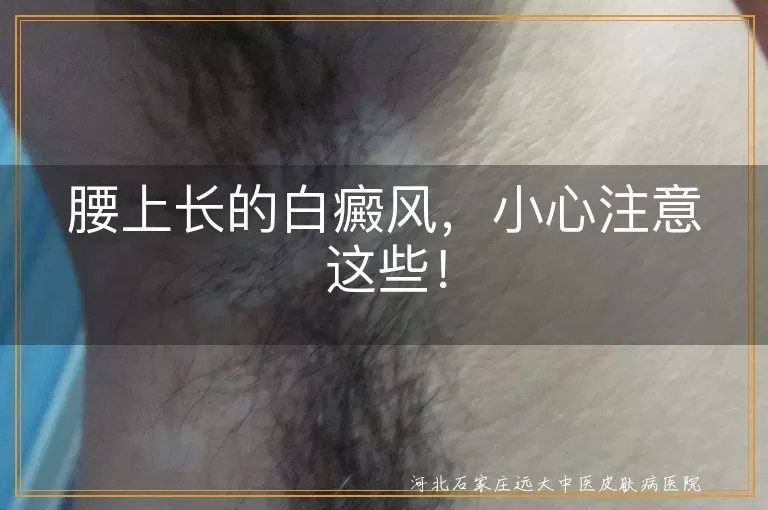 白癜风,腰部护理,饮食调理,心态调整,定期检查,避免外伤,适量运动,注意防晒