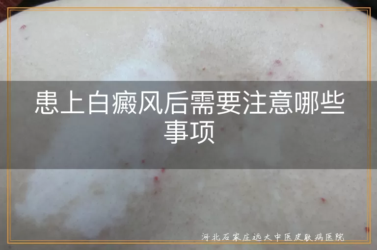 白癜风,饮食调理